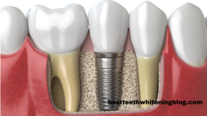 Dental implants 